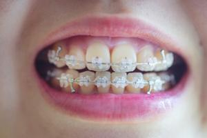 성장기 우리 아이, 치아교정 적용 대상일까?